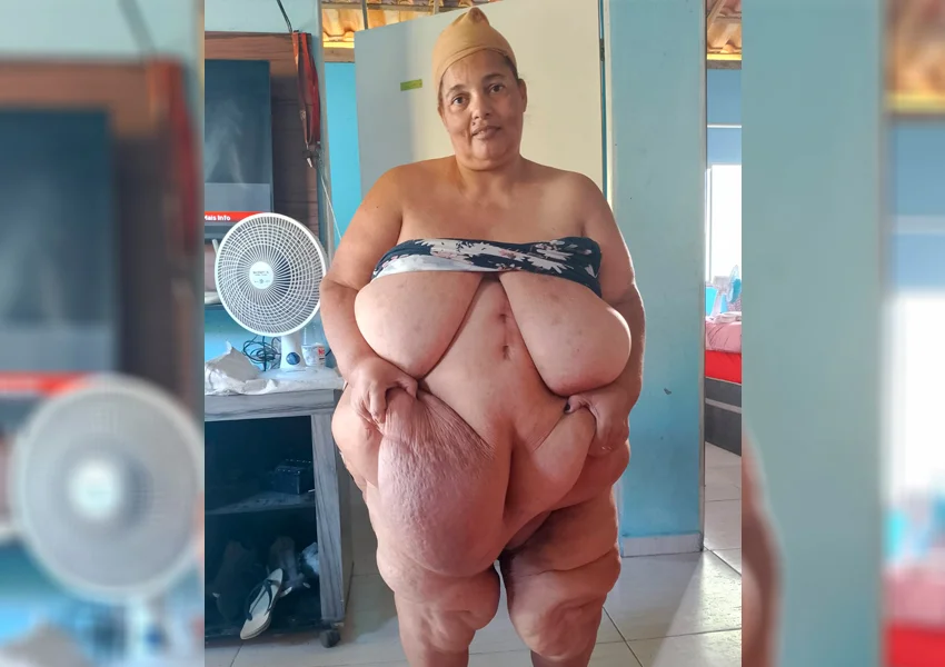 Moradora de Itambé faz apelo por cirurgia reparadora após bariátrica e pede ajuda para recuperar qualidade de vida