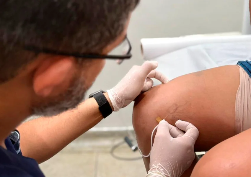 Prefeitura de Livramento inicia tratamento de varizes após triagem vascular